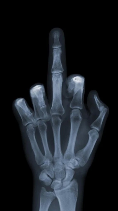 X-ray of a hand displaying a raised middle finger.